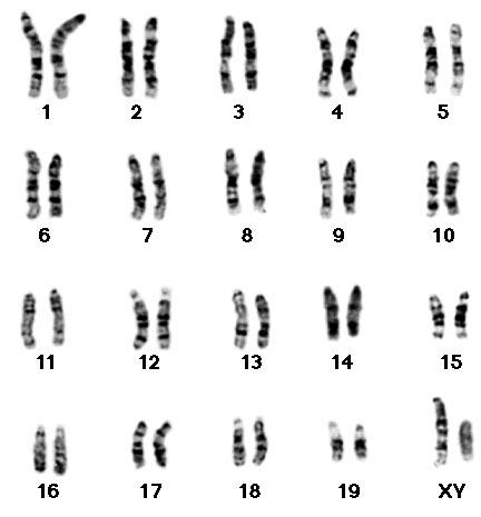 Image result for cri du chat genetics